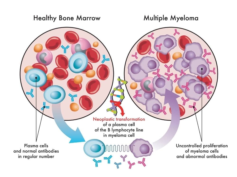 Multiple myeloma oncologists in the willamette valley oregon
